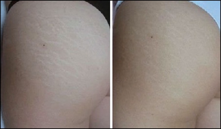 Aesthetic corrections of skin deviations with tattoos- scars and stretch marks