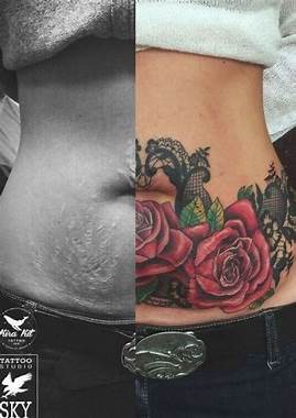 Aesthetic corrections of skin deviations with tattoos- scars and stretch marks