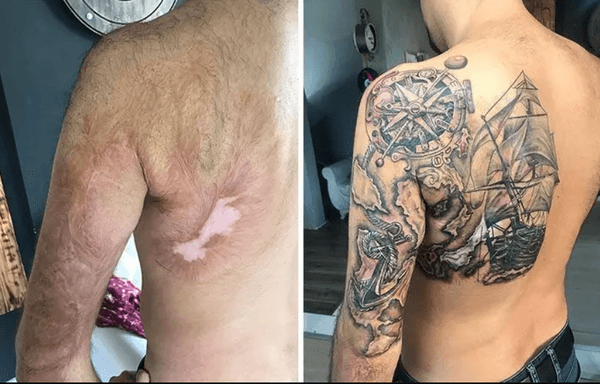 Aesthetic corrections of skin deviations with tattoos- scars and stretch marks