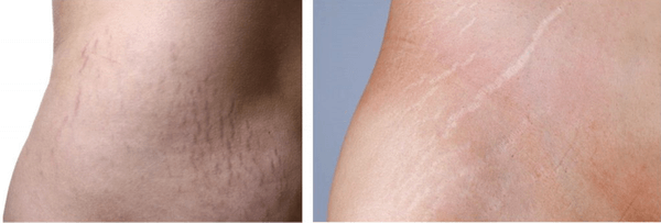 Aesthetic corrections of skin deviations with tattoos- scars and stretch marks