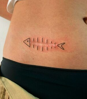 Aesthetic corrections of skin deviations with tattoos- scars and stretch marks