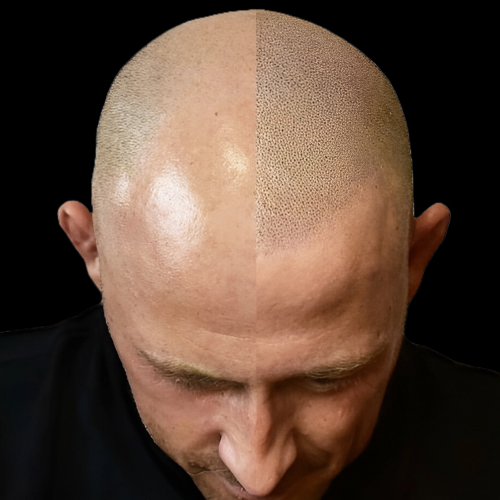 Scalp Micropigmentation